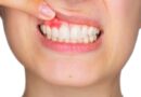 Periodontitis: la enfermedad silenciosa que provoca sangrado de encías y puede terminar con la pérdida de dientes