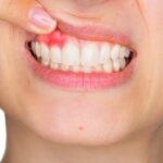 Periodontitis: la enfermedad silenciosa que provoca sangrado de encías y puede terminar con la pérdida de dientes periodontitis